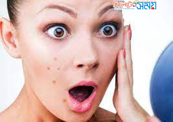 বিব্রতকর সমস্যা ব্রণ